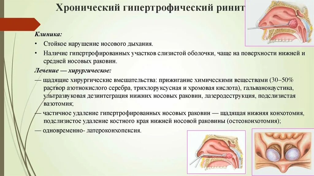 Катаральный насморк. Вазомоторный гипертрофический ринит. Хронический ринит диагноз. Хронический гипертрофический ринит. Rinito.