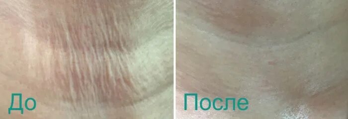 Фотографии ИАЛ-Система биоревитализации из портфолио специалистов на Профи. Идеи