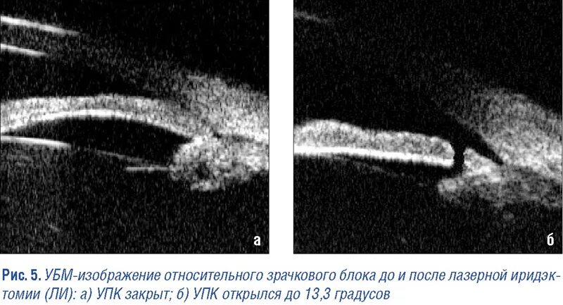 Ультразвуковая биомикроскопия (убм). Убм переднего отрезка глаза. Ультразвуковая биомикроскопия (убм). Ультразвуковая биомикроскопия глаза норма. Ультразвуковая биомикроскопия (убм).