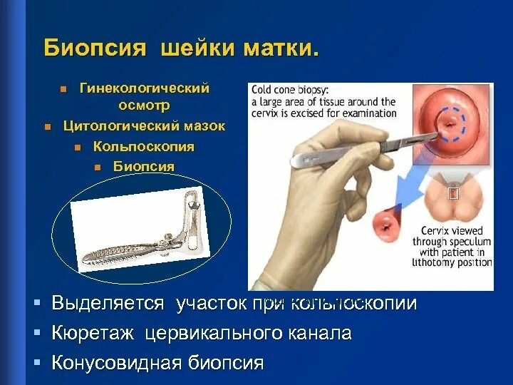 Что такое биопсия шейки матки. Взятие биопсии шейки матки. биопсия. показания, инструментарий.