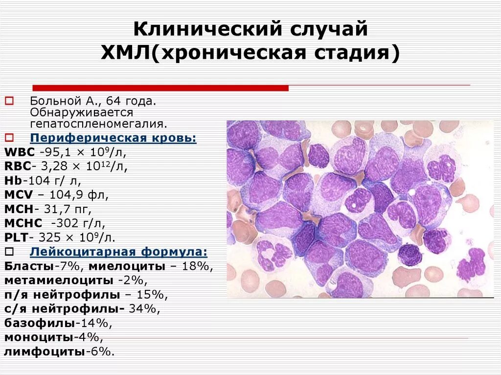 Хронический миелолейкоз картина крови. Хронический миелобластный лейкоз гистология. Хронический моноцитарный лейкоз (ХМЛ). Кровь при лимфолейкозе