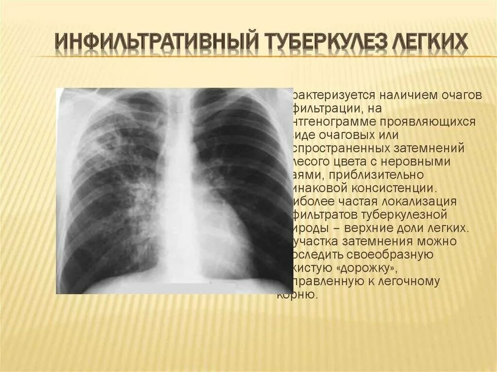 Стадия инфильтрации легких. Инфильтративный туберкулез рентгенография. инфильтративный туберкулёз лёгких рентген. инфильтративный туберкулез легких на рентгенограмме. инфильтративный туберкулез рентген описание.