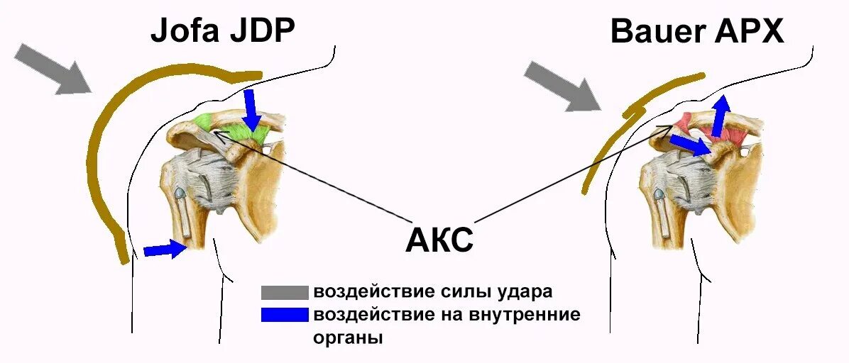 Лечение ключично акромиального артроза. Разрыв связок акромиально-ключичного сочленения шишка. Разрыв правого акромиально-ключичного сочленения. Пластика акромиально-ключичного сочленения. Лавсано-пластика разрыв акромиально-ключичного сочленения.