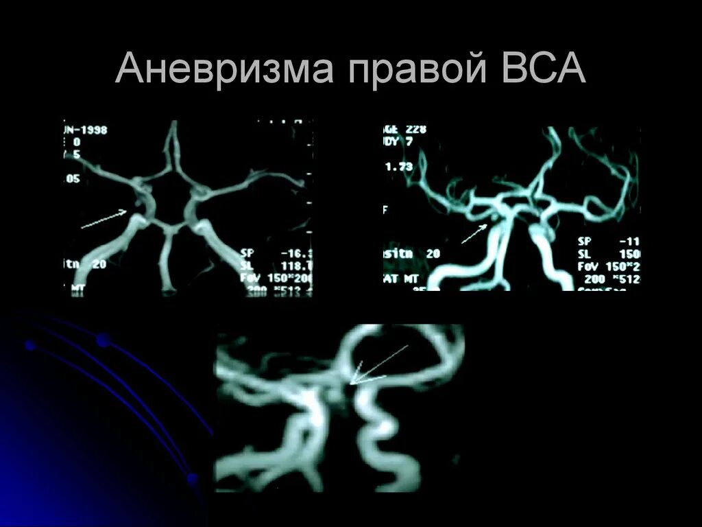 Фузиформная аневризма внутренней сонной артерии. Аневризма внутренней сонной артерии кт. Сегменты внутренней сонной артерии кт. Сифон внутренней сонной артерии на кт.