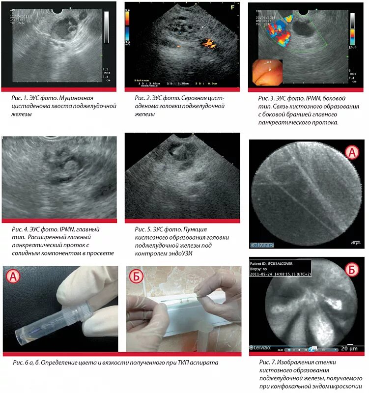 ЭУС исследование поджелудочной железы. Эндоскопическая ультрасонография желчного пузыря. Эндоскопическая ультрасонография хронический панкреатит. Эндоскопическая ультрасонография (ЭУС). Эус желудка