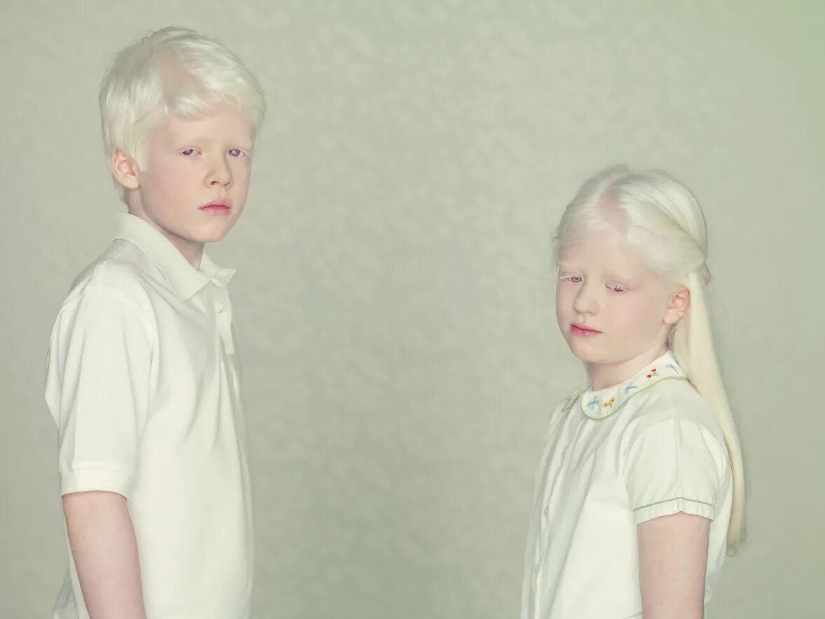 Как люди рождаются альбиносами. Глазокожный альбинизм 1 а. Глазокожный альбинизм Тип 1а. Генетические заболевания альбинизм.