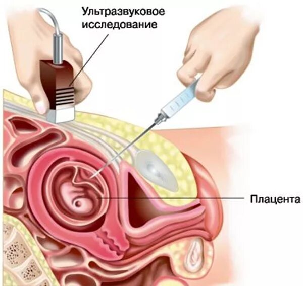 Инвазивный тест при беременности. Трансабдоминальная биопсия хориона. Плацентоцентез биопсия ткани плаценты. Трансабдоминальная биопсия ворсин хориона. Проведения биопсии ворсин хориона.