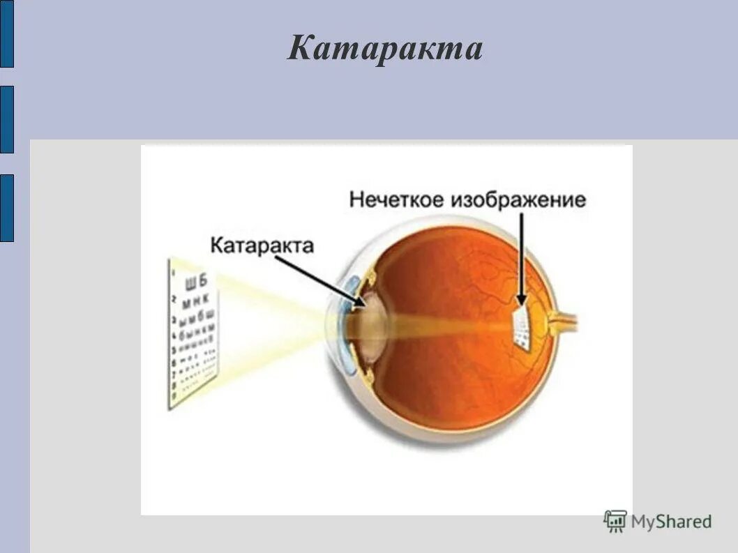 Катаракта презентация. Презентация на тему катаракта. Катаракта презентация офтальмология.