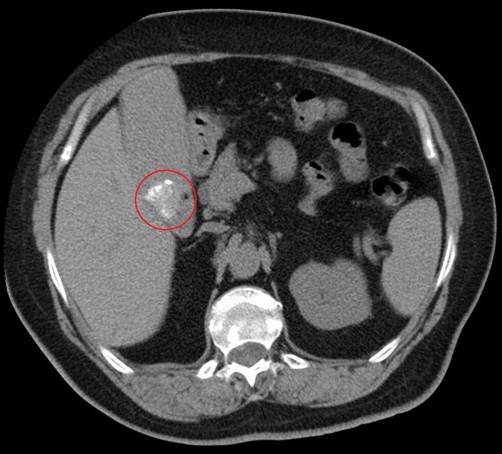 Образования печени кт. Кт мрт механическая желтуха. Конкременты поджелудочной железы кт.