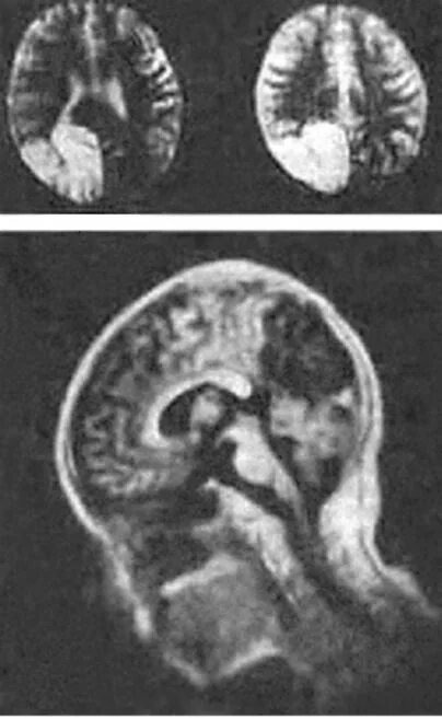 Дегенерация головного. Прогрессирующая дегенерация головного мозга. Кистозная дегенерация головного мозга. Дегенерация головного мозга у ребенка.