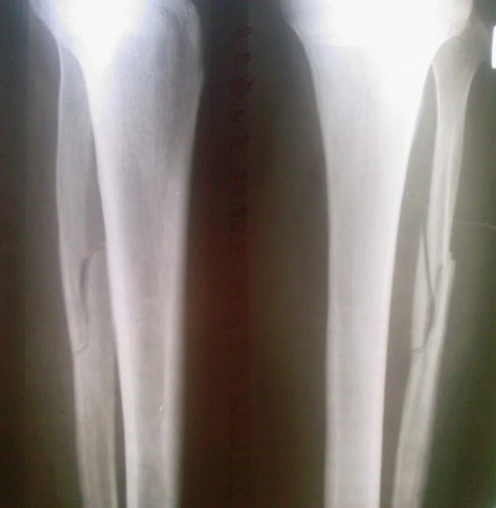 Перелом голени и малоберцовой кости. Перелом малой берцовой кости фото. Перелом малоберцовой кости рентген. Перелом нижней трети малоберцовой кости голени. Неполный перелом большеберцовой кости.