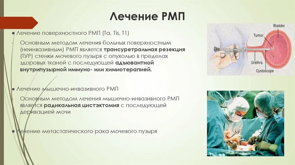 Лечение паха мочевого пузыря. Радикальная цистэктомия мочевого пузыря презентация. Мочевой пузырь для презентации. Основные этапы цистэктомии мочевого пузыря. Бцж терапия при раке мочевого