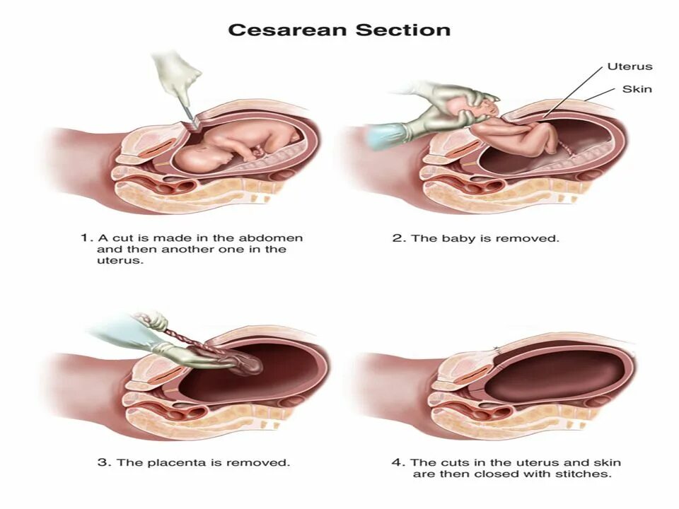 Матка через месяц после родов. Кесарево сечение разрез. Выделения после кесарево сечения. Плод при кесарево сечении извлечение. Малое кесарево сечение.