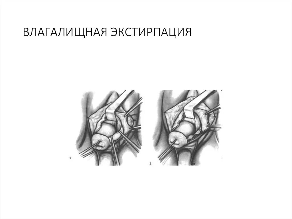 Сечение матки операция. Экстирпация матки (с лапароскопической поддержкой). Экстирпация матки (тотальная гистерэктомия). Экстирпация матки ход операции. Влагалищная экстирпация матки операция.