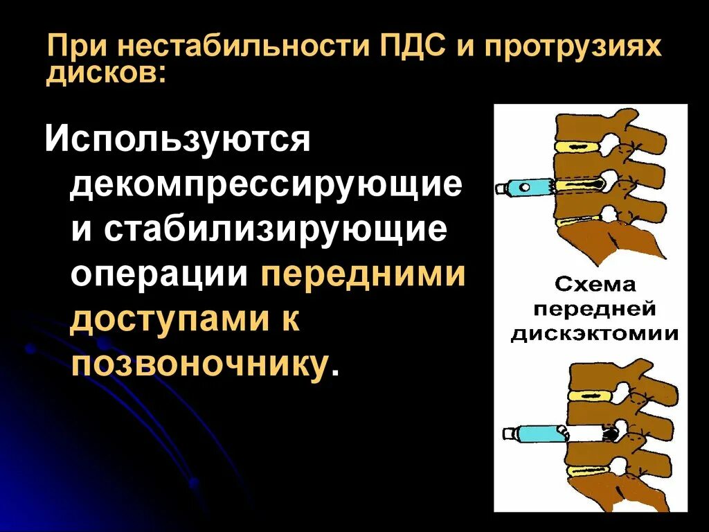 Нестабильность двигательных сегментов. Нестабильность пдс. остеохондроз позвоночника презентация. остеохондроз позвоночно-двигательного сегмента. нестабильность металлоконструкции в позвоночнике.