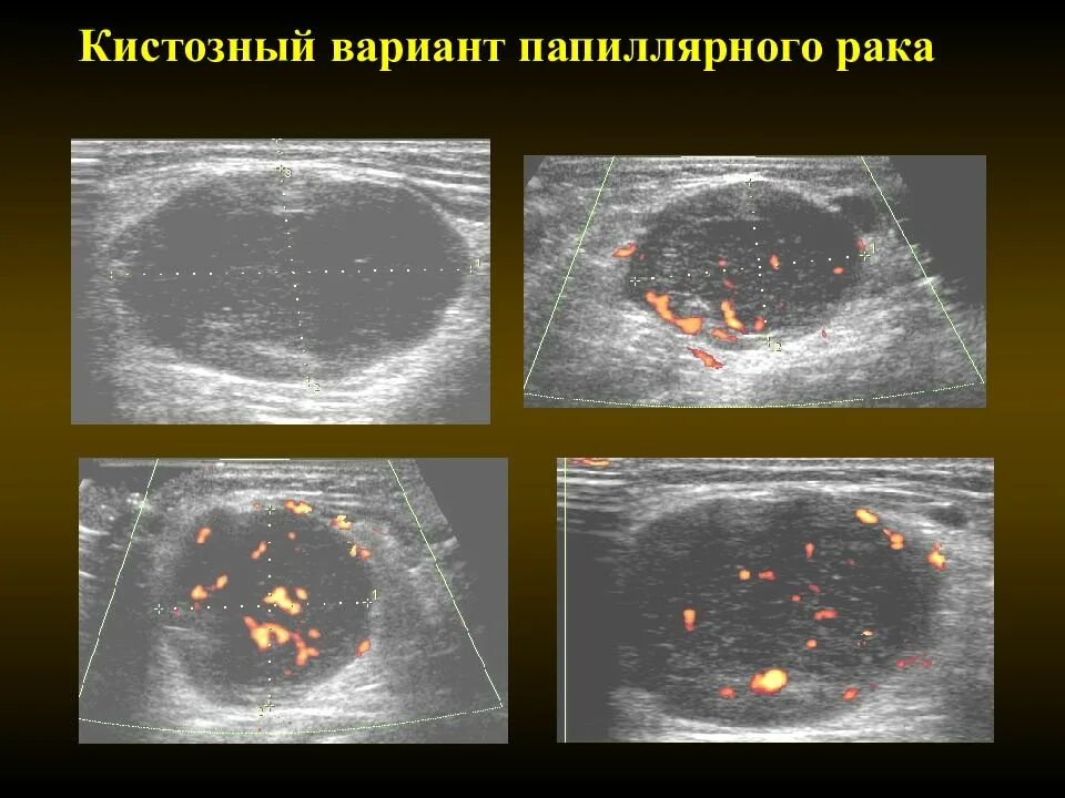 Фолликулярная карцинома щитовидной железы на УЗИ. Папиллярная карцинома щитовидной железы УЗИ. Папелярная кальцеома щетавидной железы. Папиллярный РВК зитовидной железы. Папиллярный рак после операции