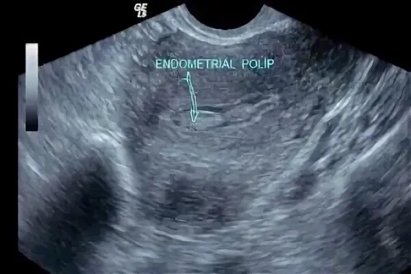 Полип матки на какой день цикла удаляют. Гидросонография полипы. Эндометриальный полип на УЗИ. Полип эндометрия в матке. Эхограммы полип эндометрия.