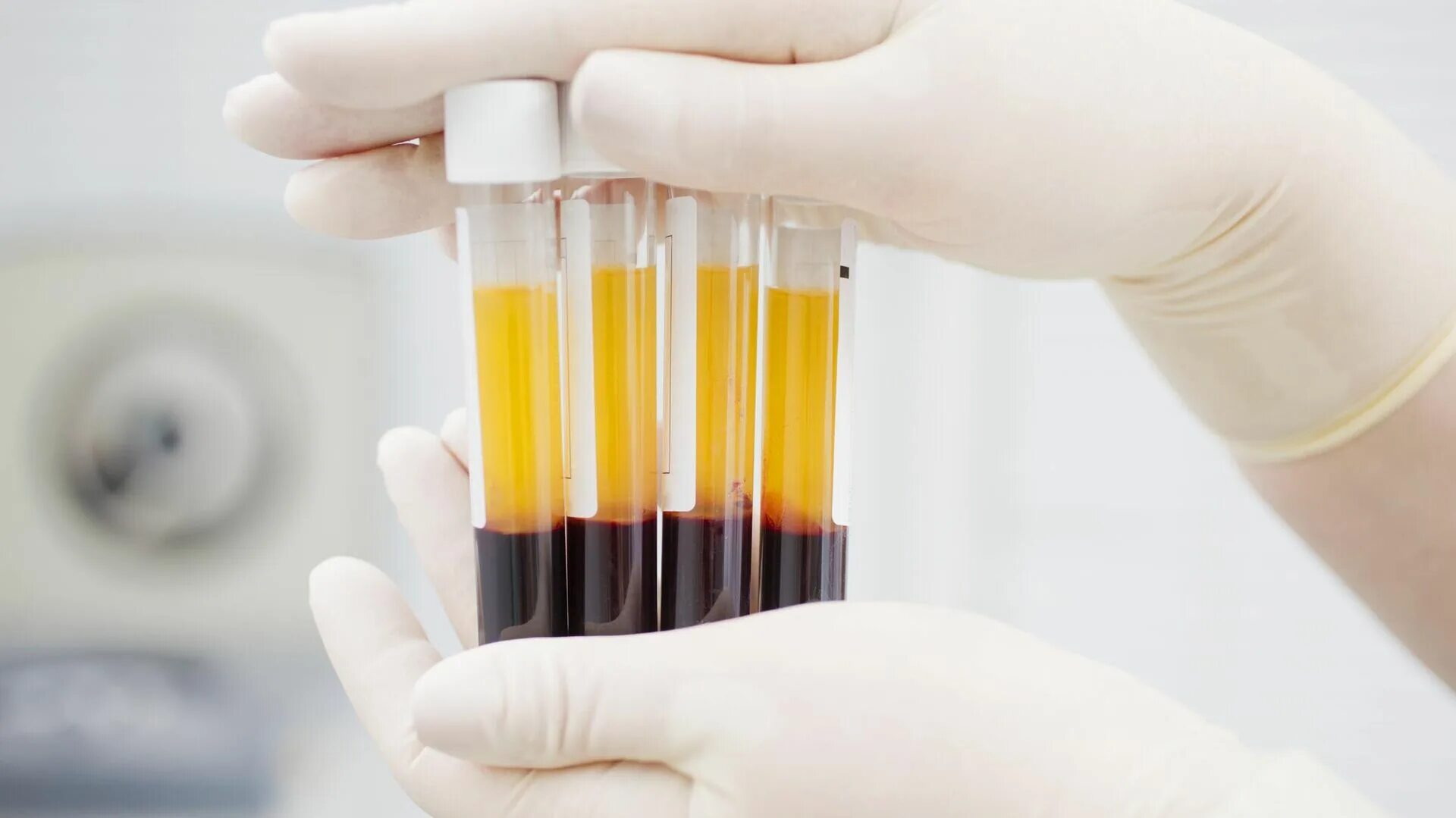 PRP терапия Platelet Rich Plasma. Плазмотерапия пробирка PRP. Плазма крови в пробирке. Плазмолифтинг (плазмотерапия). Плазма крови в лицо