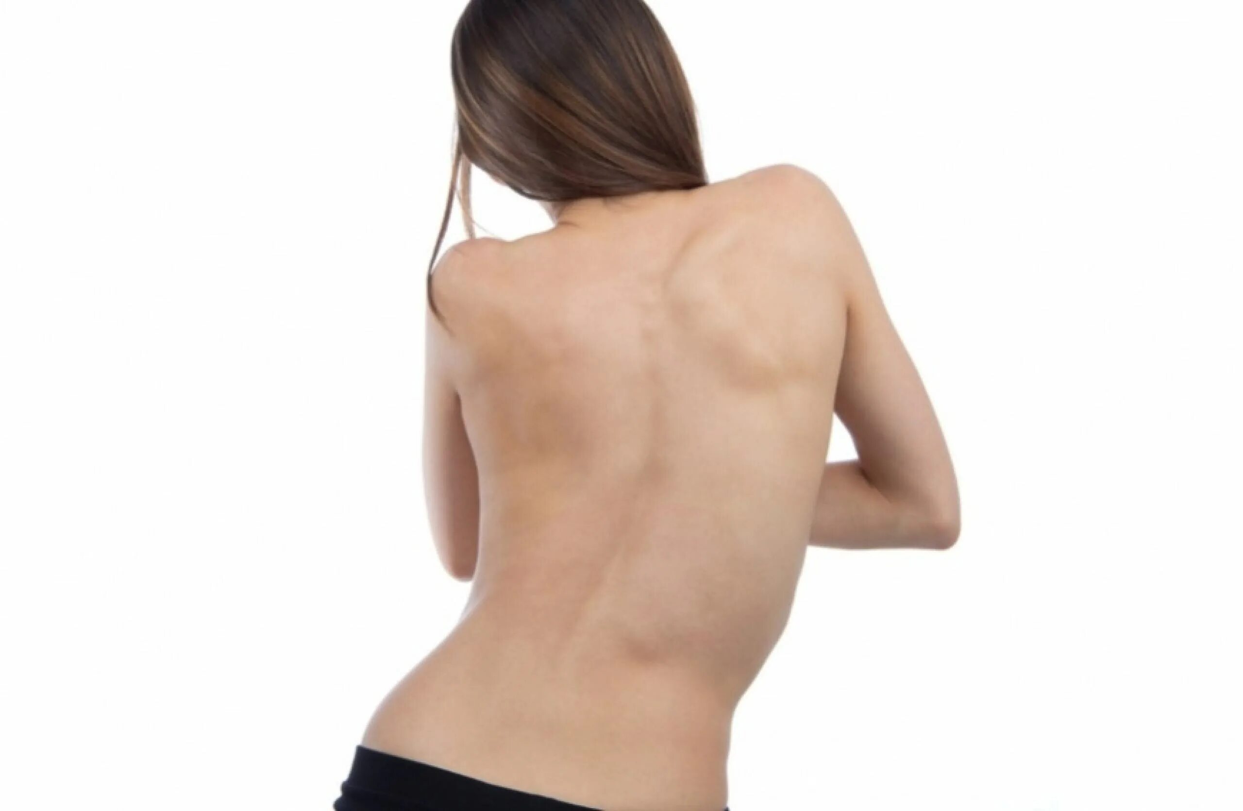 Осанка 2 степени. Сколиоз спереди вид спереди. Сколиоз 3 степени угол искривления. Строение позвоночника сколиоз. Отличие сколиоза от нарушения осанки.