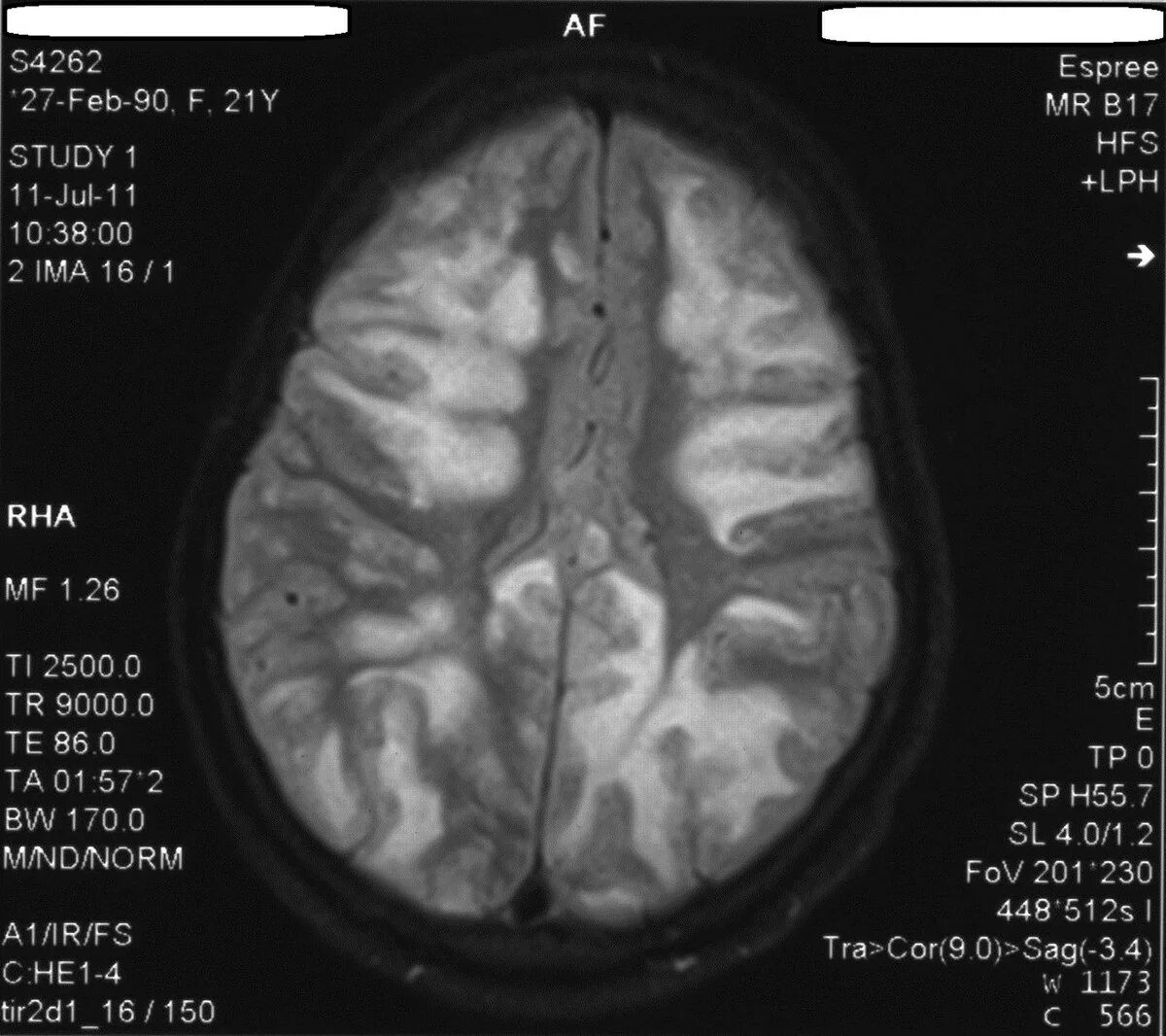 Заболевание головного мозга лечение. Демиелинизация головного мозга мрт. Демиелинизирующие очаги головного мозга. Очаги демиелинизации головного мозга на мрт. Демиелинизирующие заболевания головного мозга на мрт.
