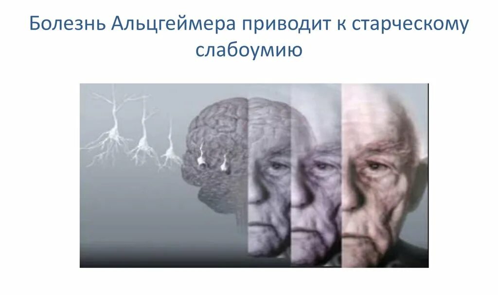 Привести к слабоумию. Болезнь Альцгеймера. Старческое слабоумие деменция. Деменция Альцгеймера. Болезнь Альцгеймера презентация.