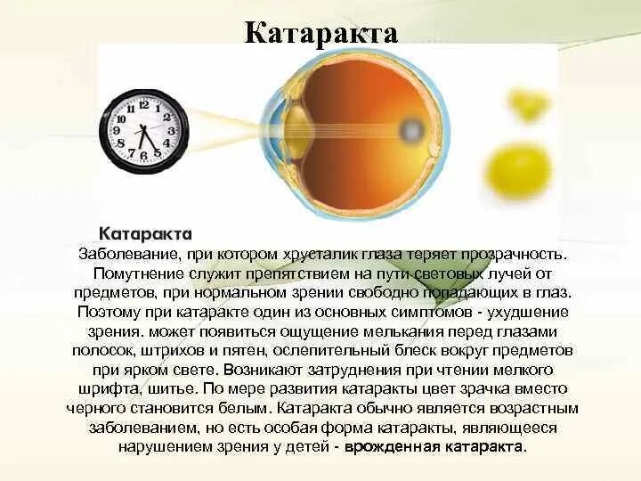 Заболевание глаз катаракта. Катаракта презентация. Заболевания хрусталика презентация. Строение глаза катаракта.