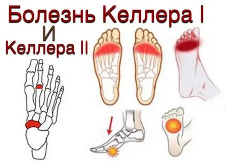 Болезнь келлера 2 степени