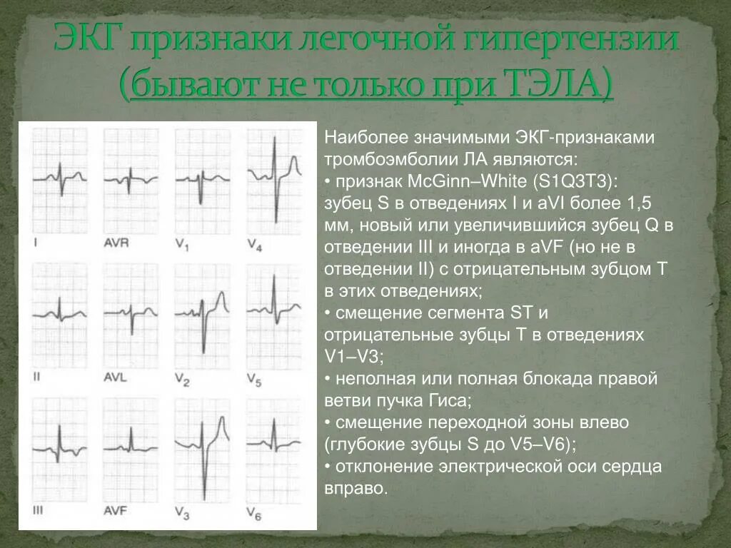 Изменение зубца q. ЭКГ зубец s в v5-v6. Глубокий зубец s в 1 отведении на ЭКГ. Зубец q в v1 отведении на ЭКГ. Патологический зубец s в грудных отведениях.