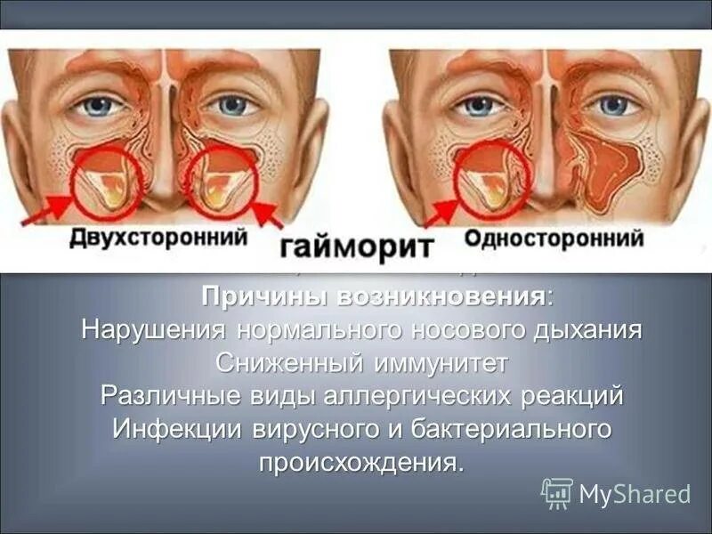 Гайморовые пазухи. Острый односторонний гайморит. Симптоматика гайморита.