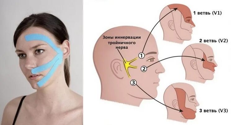 Воспаление тройничного нерва. Воспаление тройничного нерва на лице. При воспалении тройничного нерва. Неврит тройничного нерва. Воспаление нерва можно ли греть