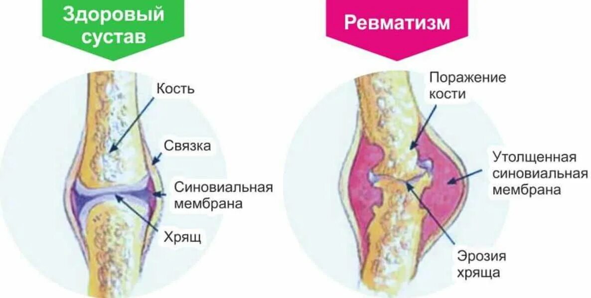 Ревматическое поражение суставов.