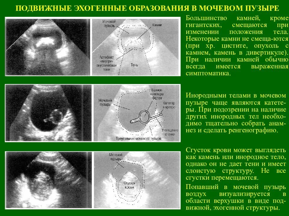 Образования мочевого пузыря на УЗИ. Пристеночное образование в мочевом пузыре. Объемное образование мочевого пузыря. Сгустки в мочевом пузыре на УЗИ. Неприятно в мочевом пузыре