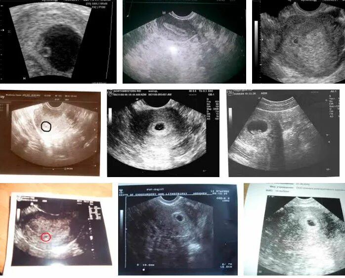 Вторая неделя беременности форум. Беременность на 2-3 недели беременности на УЗИ. УЗИ 2 недельной беременности. Беременность 1-2 недели от зачатия эмбрион. УЗИ 1-2 недели беременности.