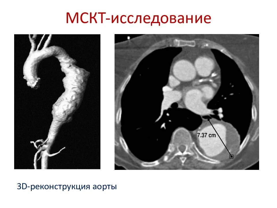 Мскт аортография