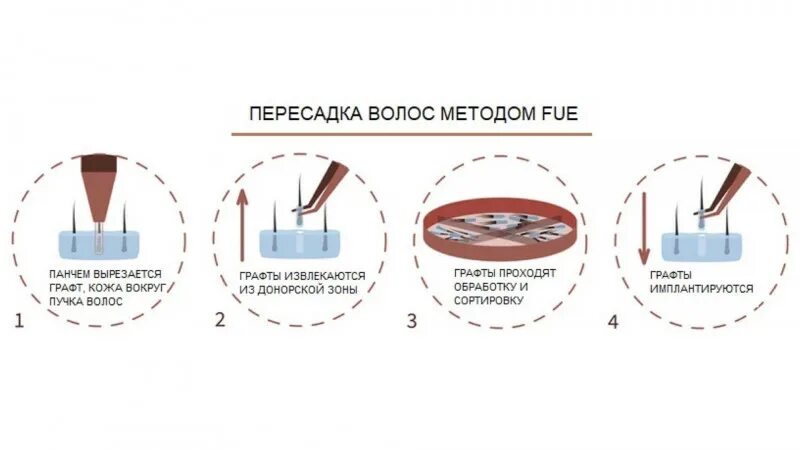 Трансплантация волос методом fue. Графты для пересадки волос. Пересадка волос бесшовным методом.