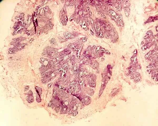 Железистый полип эндометрия гистология. Железистая гиперплазия эндометрия патанатомия. Эндометрия матки узи гиперплазия эндометрия. Стромальная гиперплазия эндометрия. Неатипическая гиперплазия.