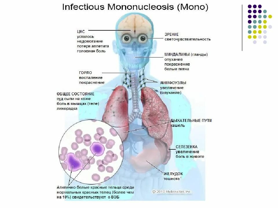 Мононуклеоз это. Инфекционный мононуклеоз (болезнь Филатова-Пфейффера). Инфекционный мононуклеоз ротовая полость. Фульминантный инфекционный мононуклеоз. Аденовирусная мононуклеоз.