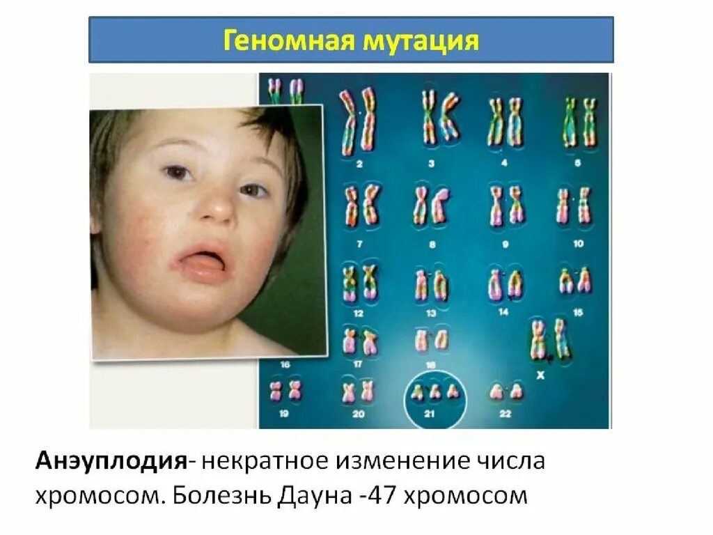 Синдром Дауна геномная мутация. Геномные и хромосомные заболевания. Хромосомные заболевания синдром Дауна. Хромосомные мутации болезни. Синдром дауна по наследству