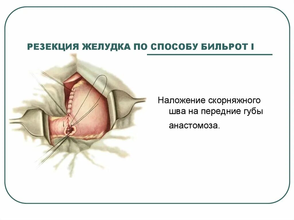 Операция резекция печени. Резекция желудка по Бильрот-i. Резекция желудка по Бильрот 1. Резекция желудка по Бильрот 1 и 2 отличия.