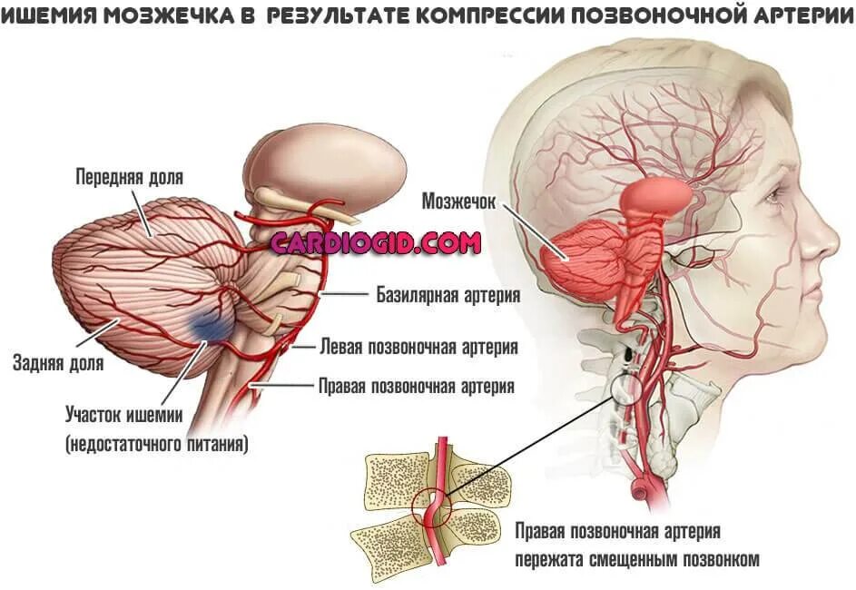 Вбн диагноз в неврологии что. Ишемический инсульт поражения артерий. Инсульт базилярной артерии. Ишемический инфаркт мозжечка. Инфаркт мозжечка артерии.