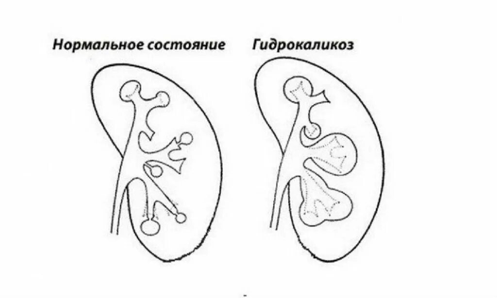 Почка уплотнена что это значит