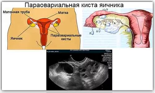 Болит правая сторона яичников. Паратубарная киста трубы матки. Киста маточной трубы на УЗИ. Параовариальная киста на УЗИ. Параовариальные образования яичников.