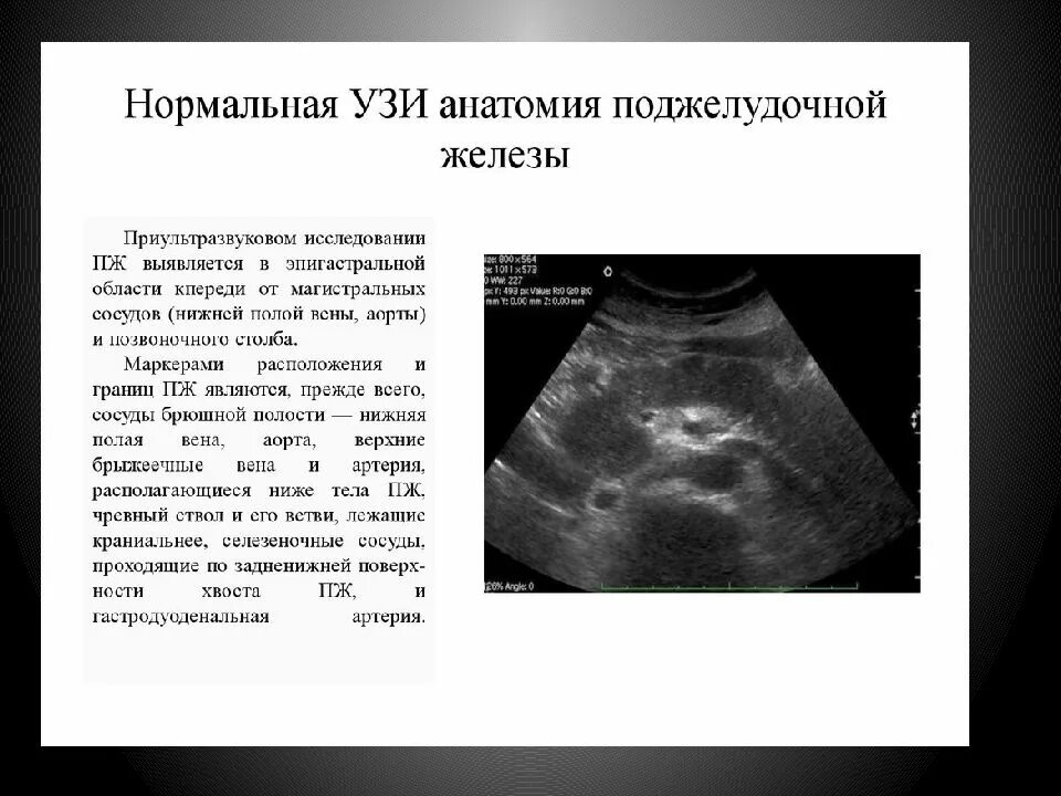 Ультразвуковое исследование печени и забрюшинного пространства. Ультразвуковое исследование поджелудочной железы позволяет выявить:. УЗИ картина нормальной поджелудочной железы.. Трансабдоминальное УЗИ поджелудочной железы. Нормы органов брюшной полости