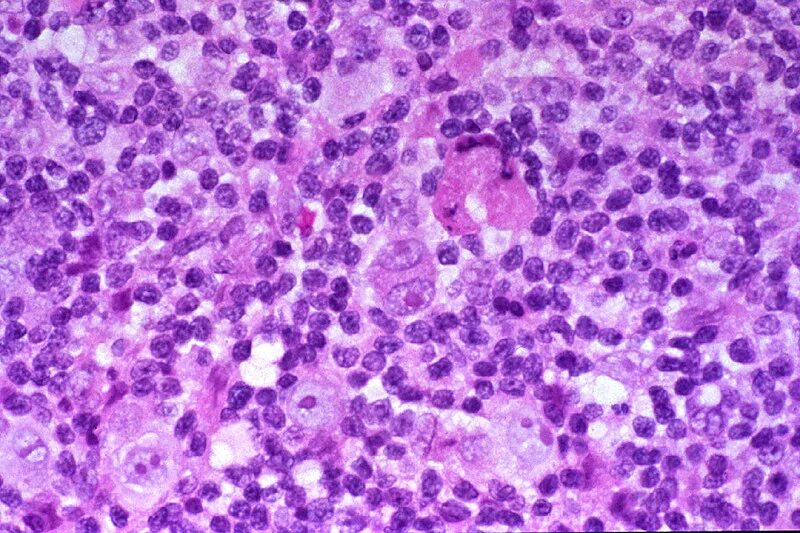 Многоядерные клетки березовского-рид-штернберга. Клетки рид-березовского-штернберга. Клетки рида. Многоядерные клетки березовского-рид-штернберга. Клетки ходжкина и рид-штернберга.