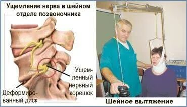 Защемление шейного сосуда симптомы