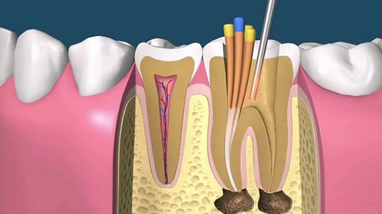 4 Канальный пульпит зуба. Пульпит корневого канала. Пульпит 3 канального зуба.