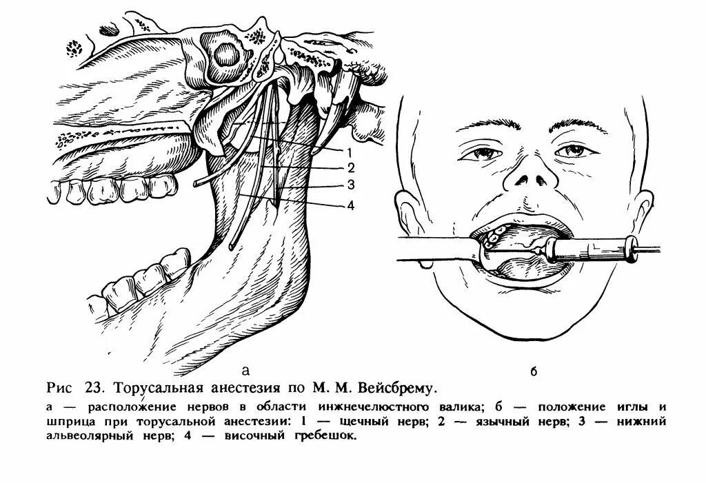 Торусальная анестезия нижней челюсти. Проводниковая анестезия нижней челюсти. Проводниковая анестезия нижней челюсти мандибулярная. Проводниковая анестезия нижней челюсти торусальная.