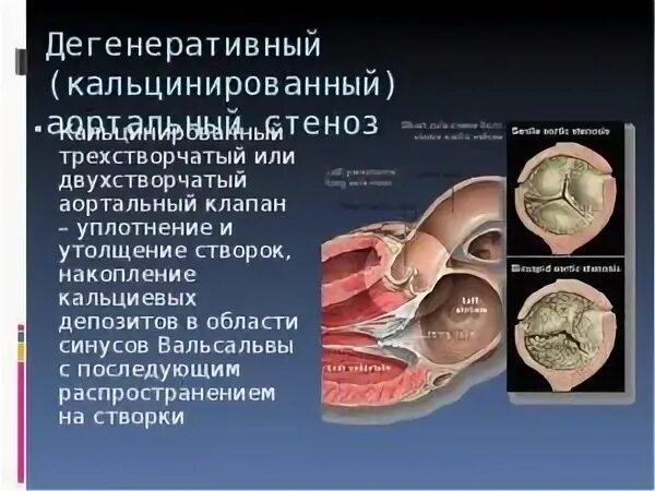 Уплотнение клапана аорты