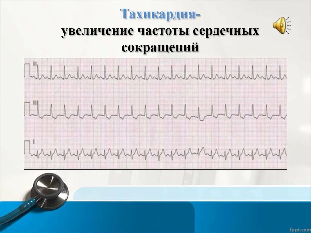 Повышение частоты сердечных сокращений. Тахикардия это увеличение частоты сердечных сокращений на. Механизм увеличения ЧСС. Тахикардия изображение. Усиливают частоту сердечных сокращений