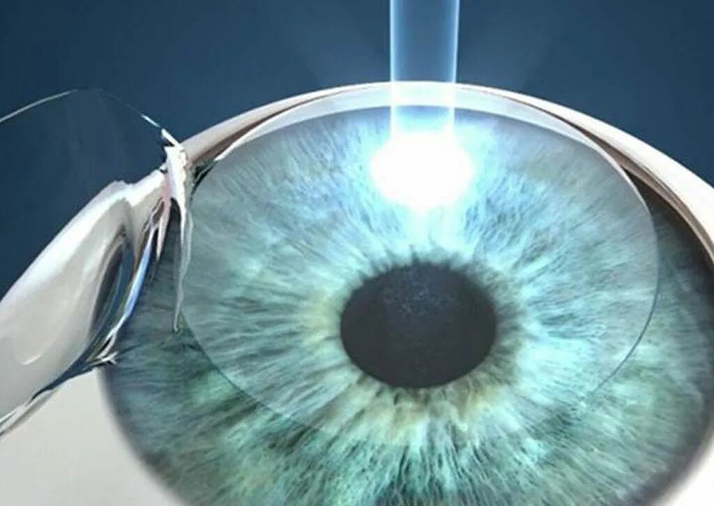 Лазерная коррекция зрения спустя много лет отзывы. Фемто ласик. Коррекция зрения Фемто ласик.